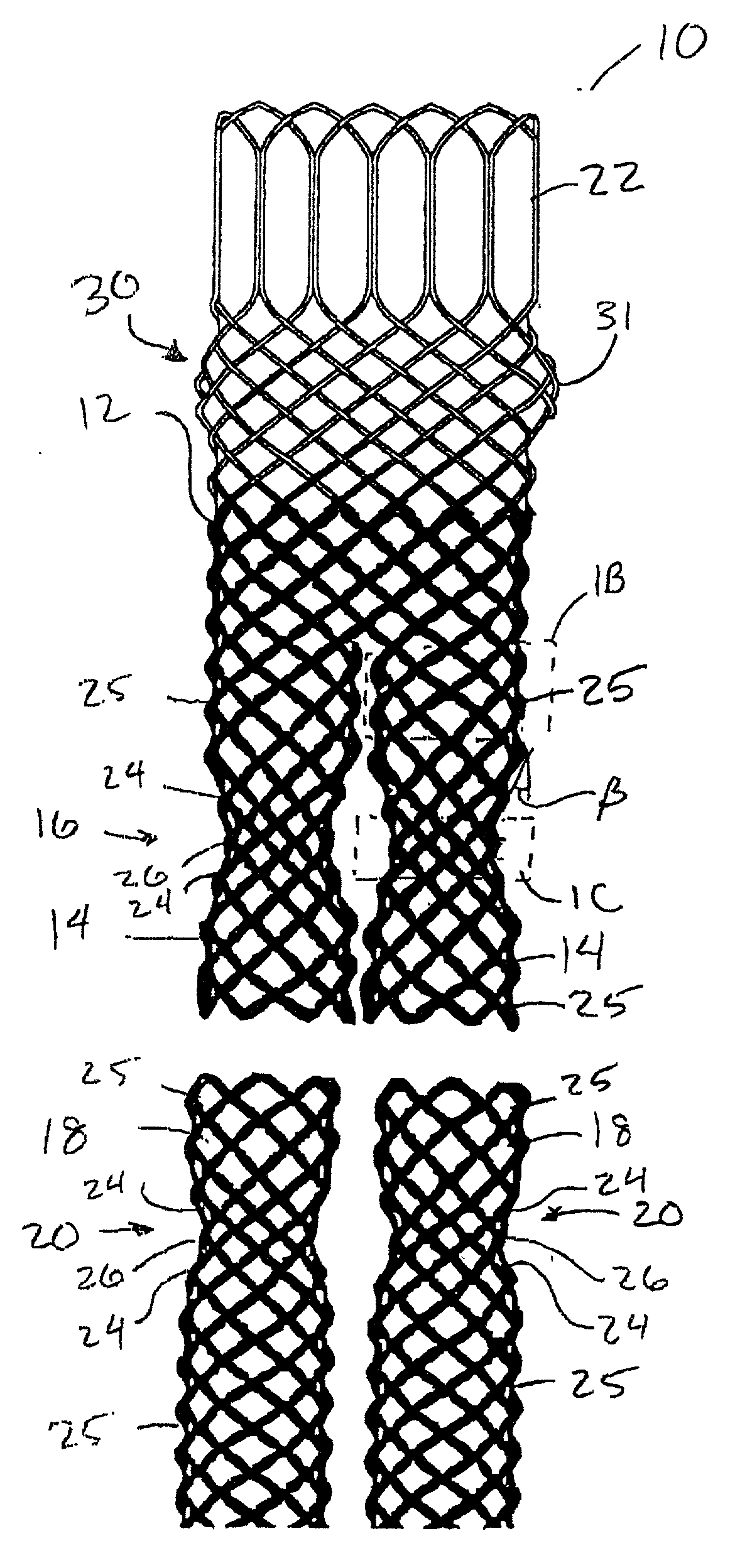 Braided modular stent with hourglass-shaped interfaces