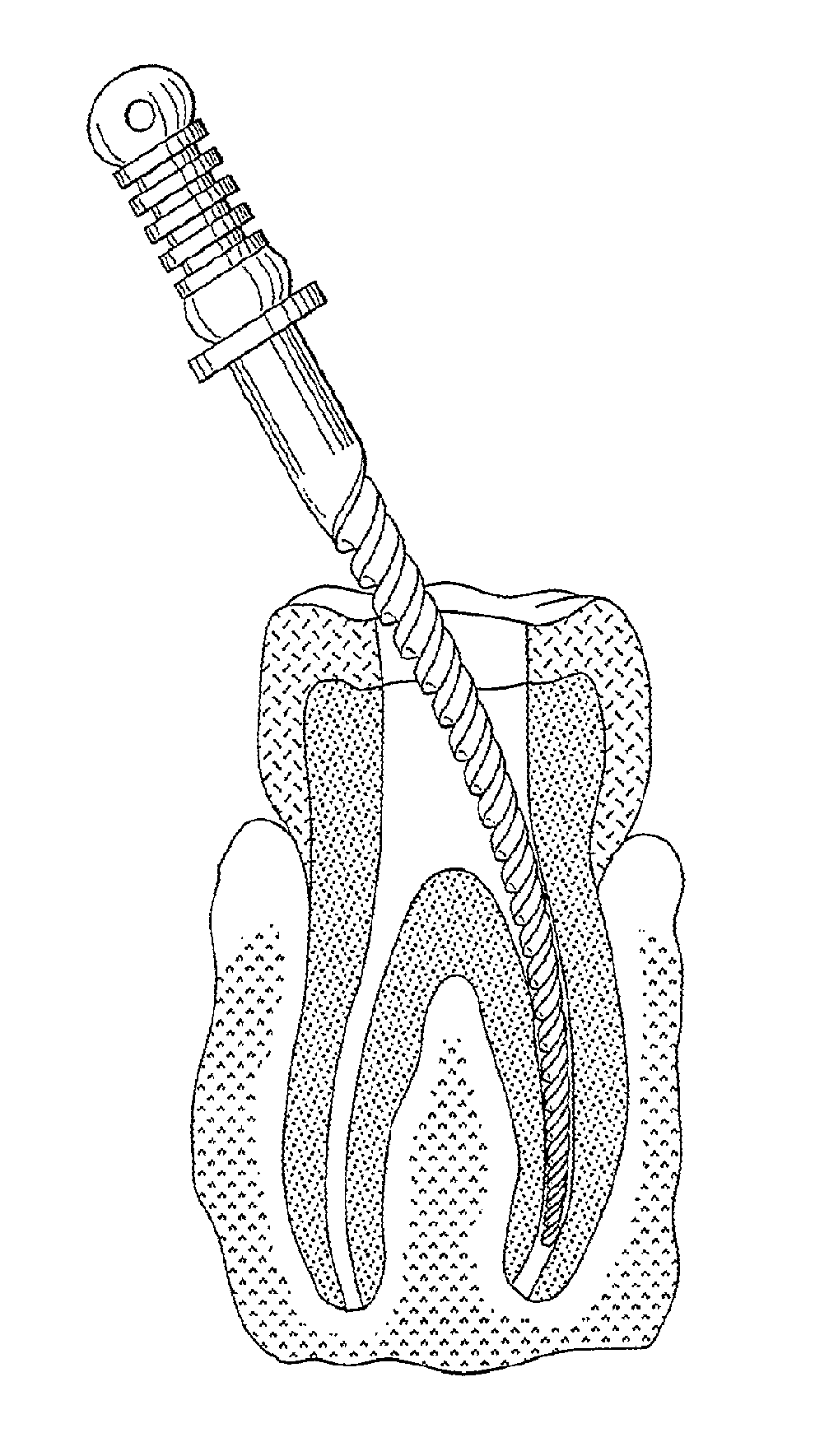 Fatigue-Resistant Nitinol Instrument