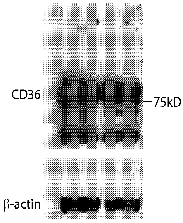 Use of cd36 to identify cancer subjects for treatment