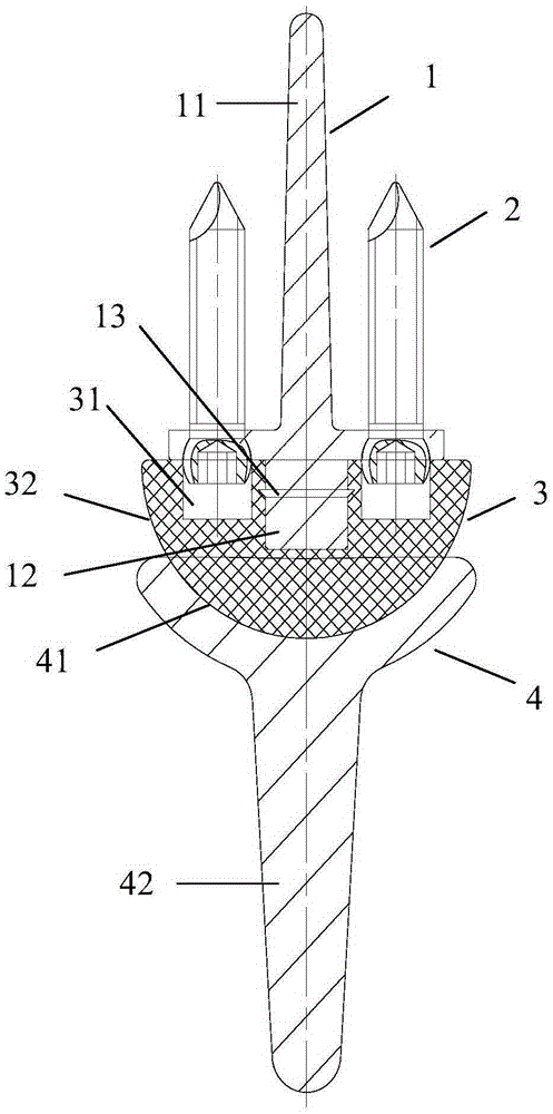 Wrist joint prosthesis