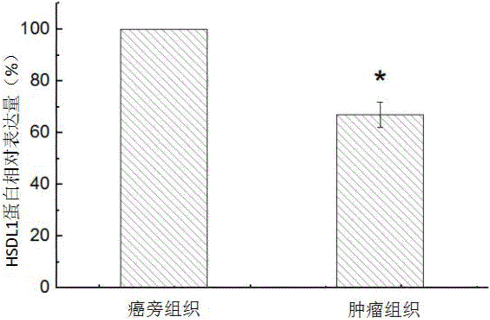 Application of HSDL1 to diagnosis and treatment of osteosarcoma