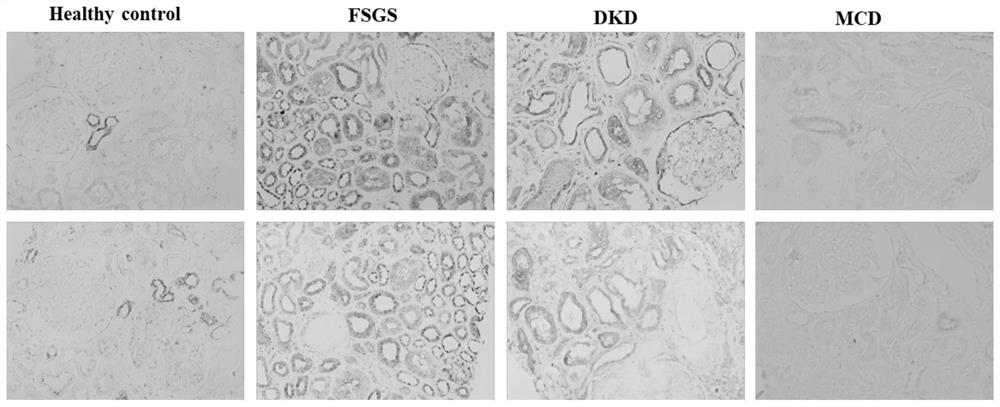 Application of retinoic acid receptor reactive protein 1 as a biomarker in chronic kidney disease