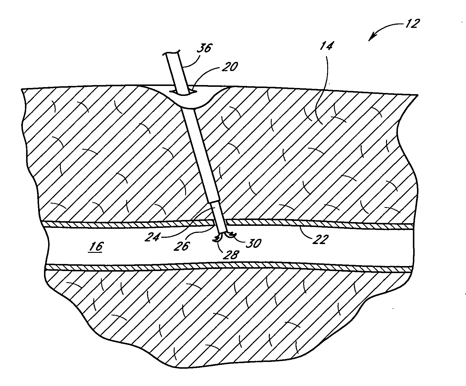 Suturing device and method