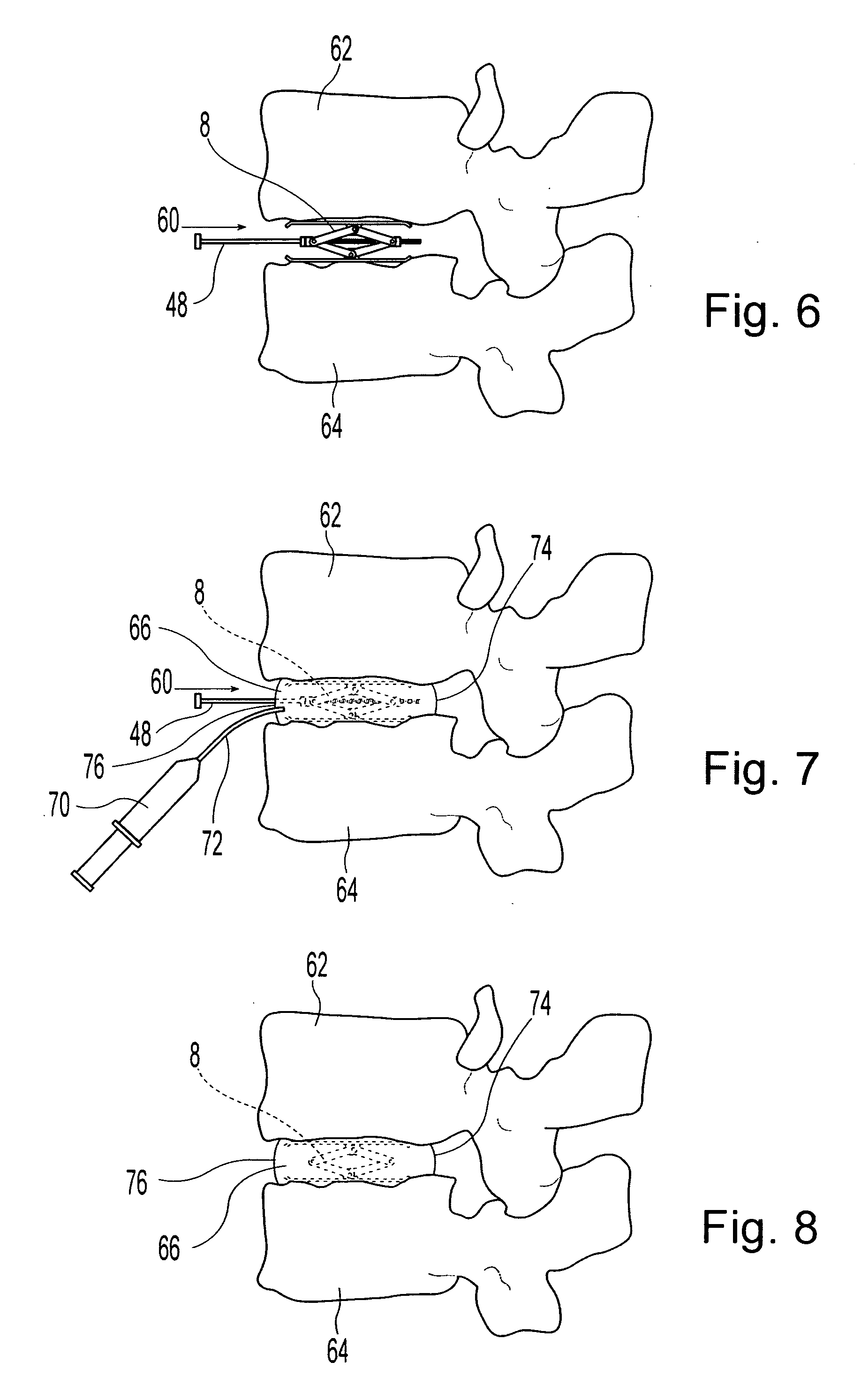 Method and relaxable distracters for in-situ formation of intervertebral disc prosthesis