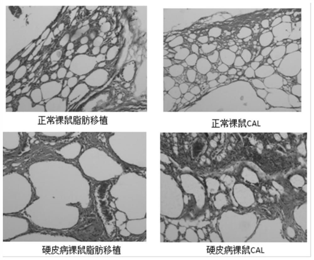 Application of adipose-derived stem cells in localized scleroderma