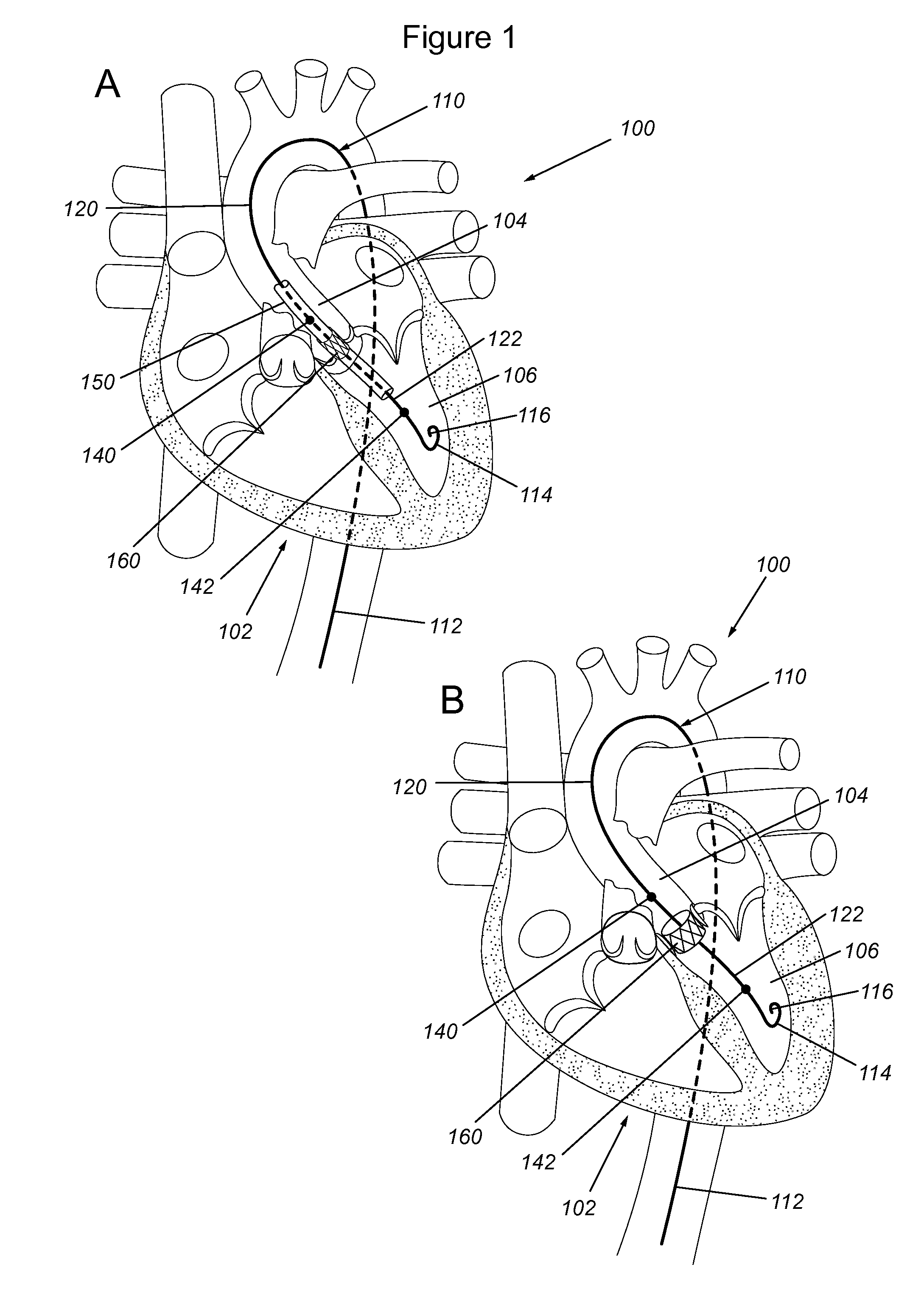 Transcatheter aortic valve implantation pressure wires and uses thereof