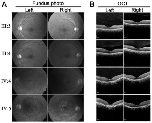 Application of ZNF124 gene in early screening or auxiliary diagnosis of retinal pigment degeneration disease