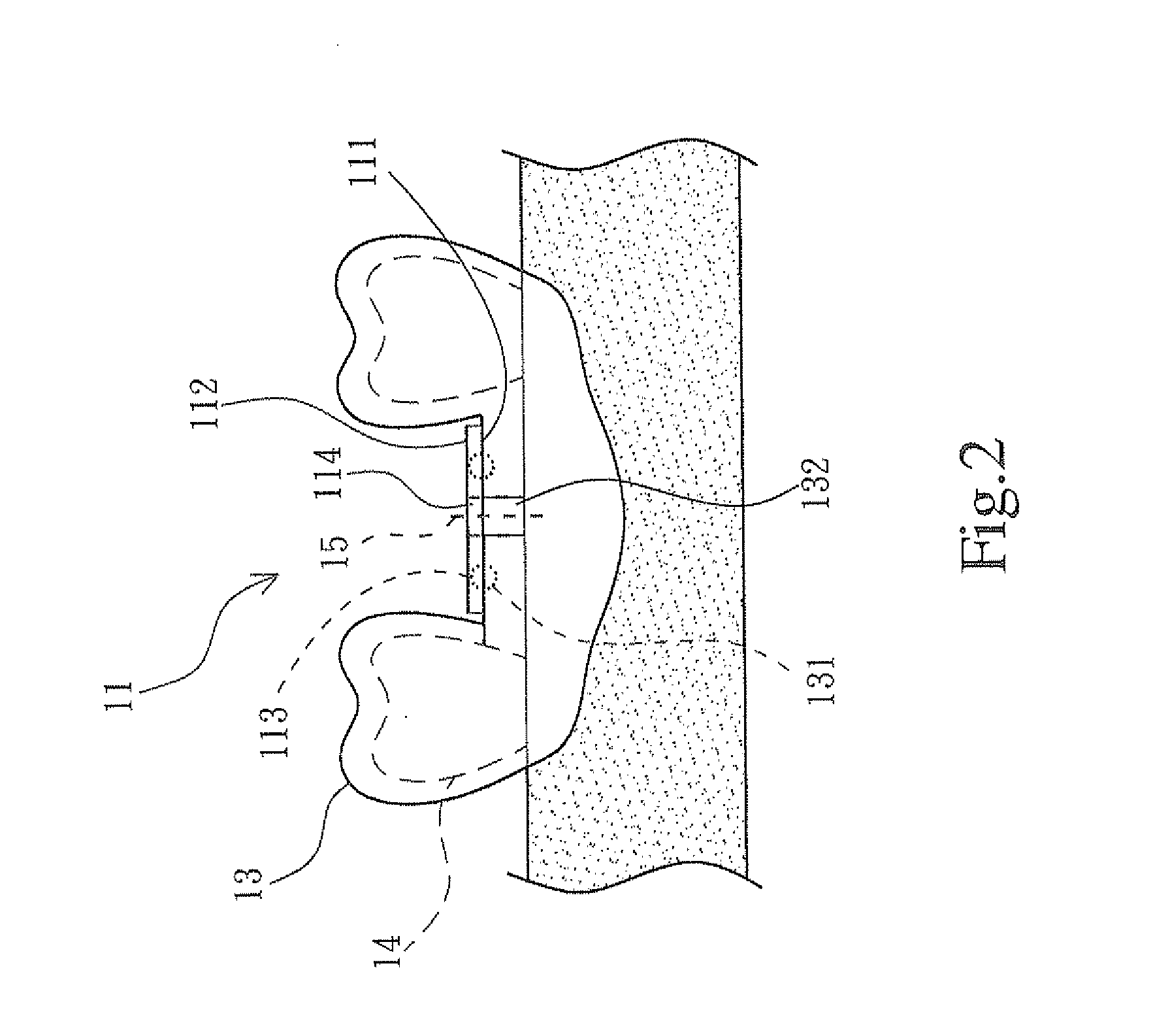 Method of manufacturing surgical template positioning device