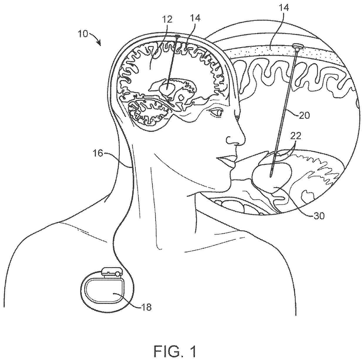 Systems and method for deep brain stimulation