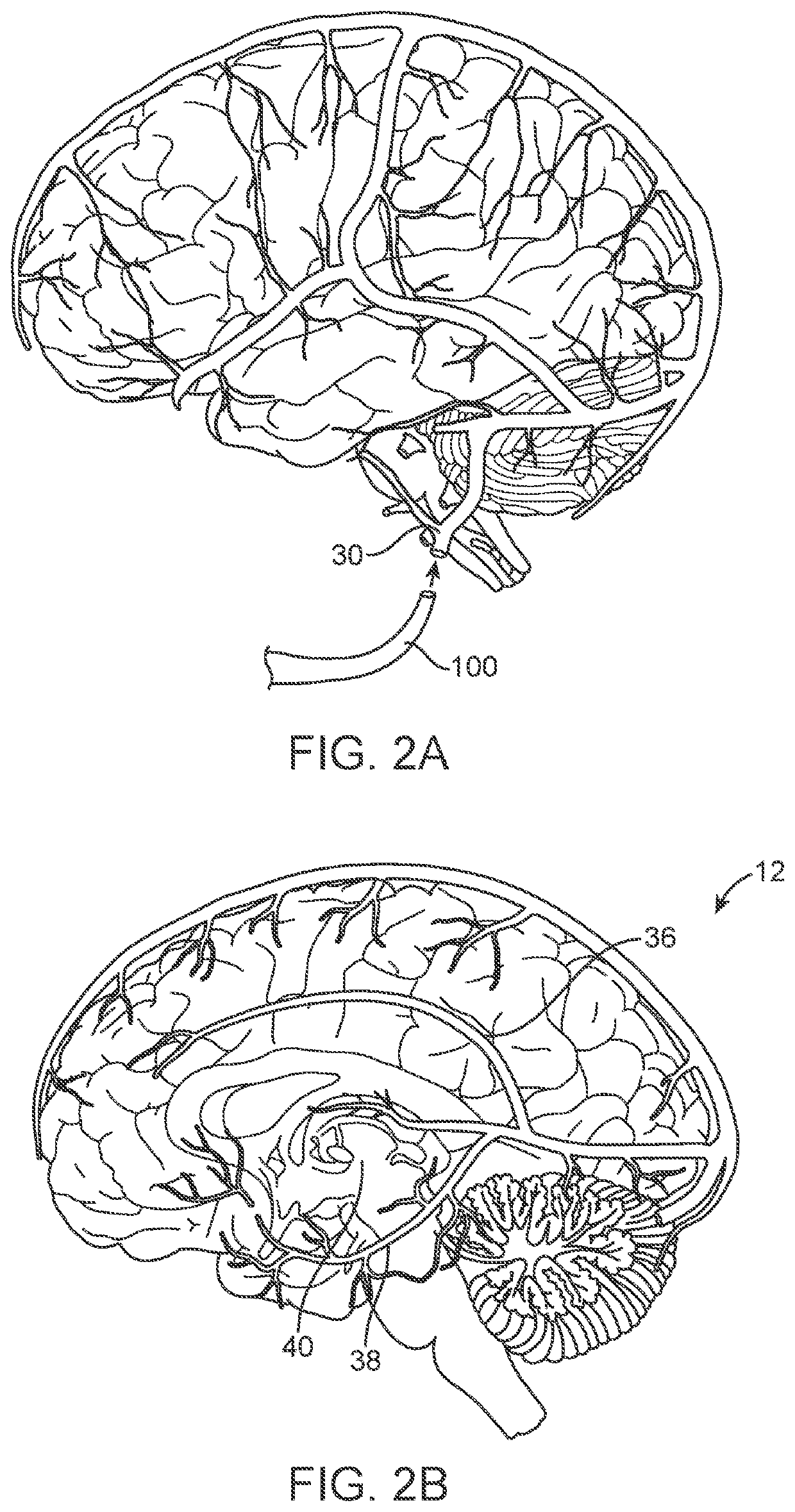 Systems and method for deep brain stimulation