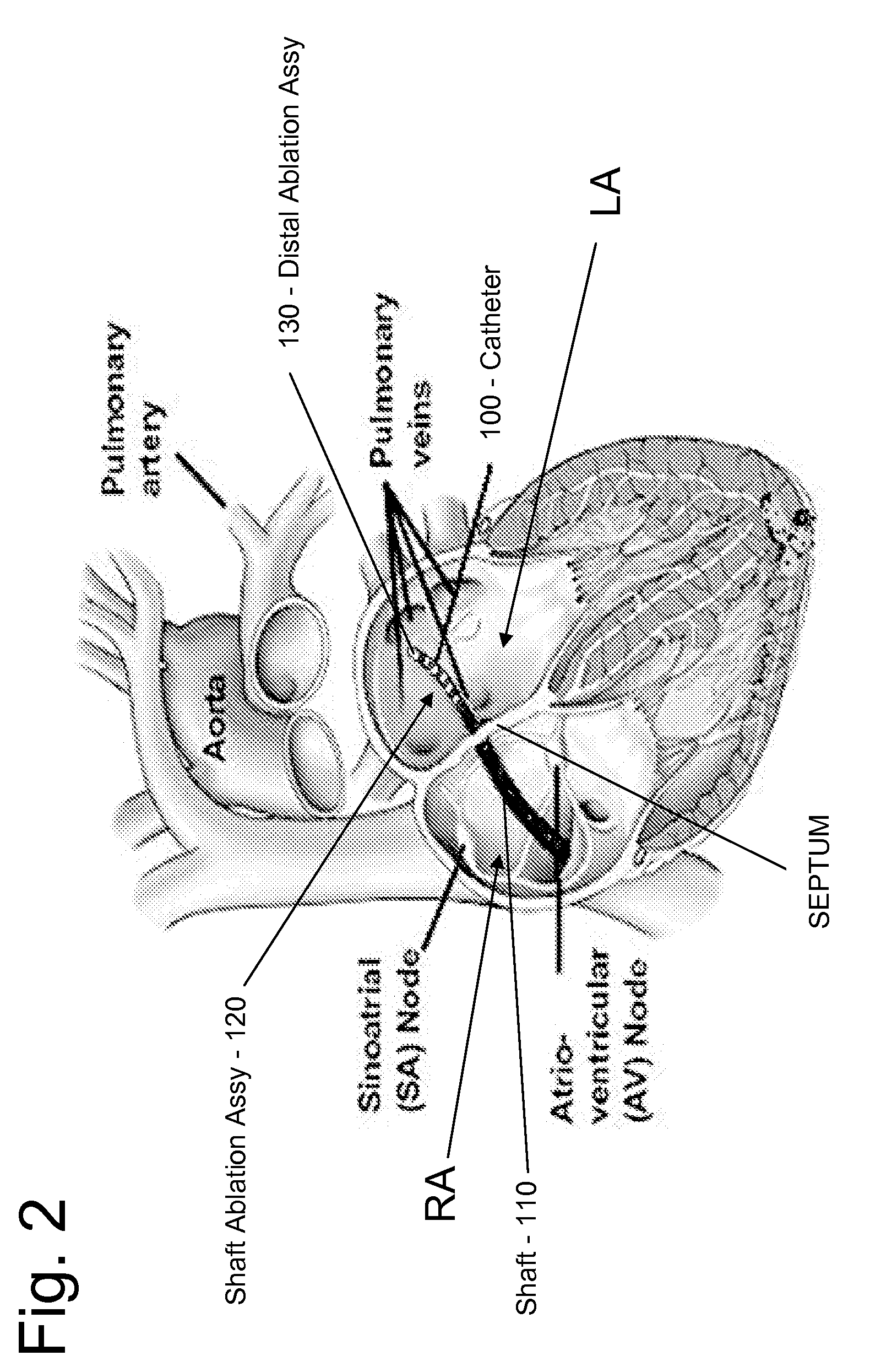 Irrigated Ablation Catheter System and Methods
