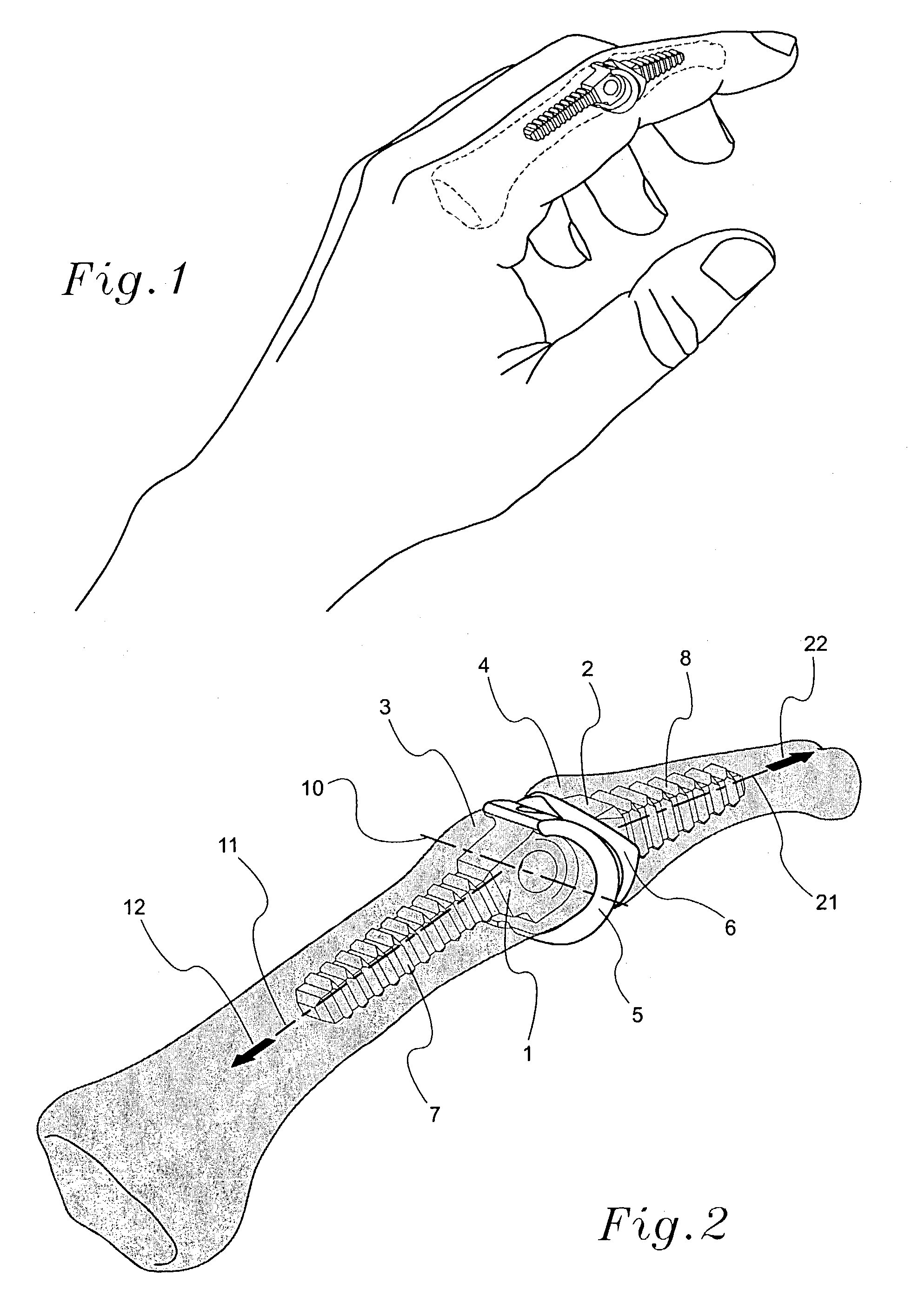 Prosthetic device and method for total joint replacement in small joint arthroplasty