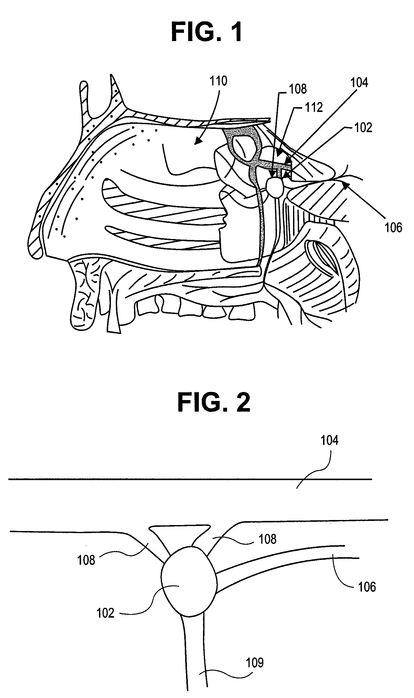 Method and device for the treatment of headache