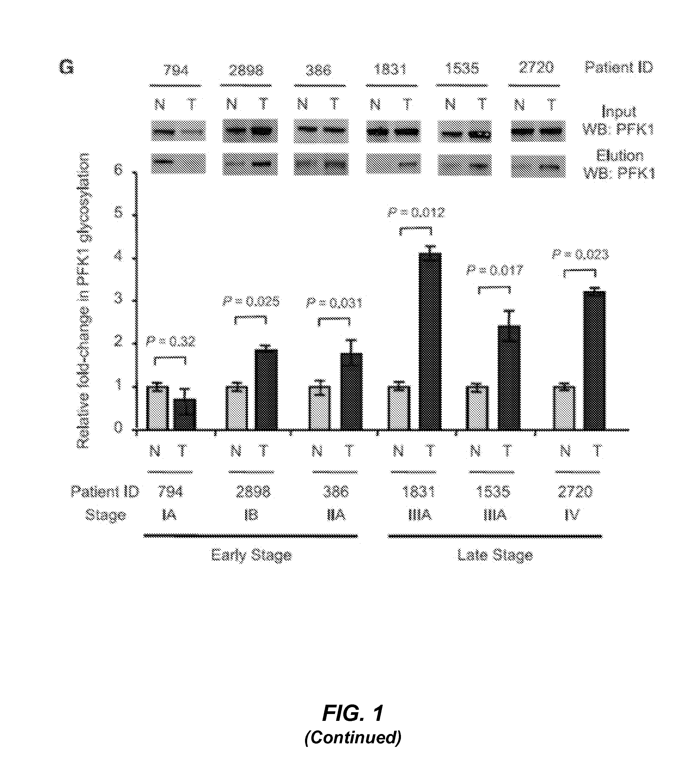 Targeting phosphofructokinase and its glycosylation form for cancer