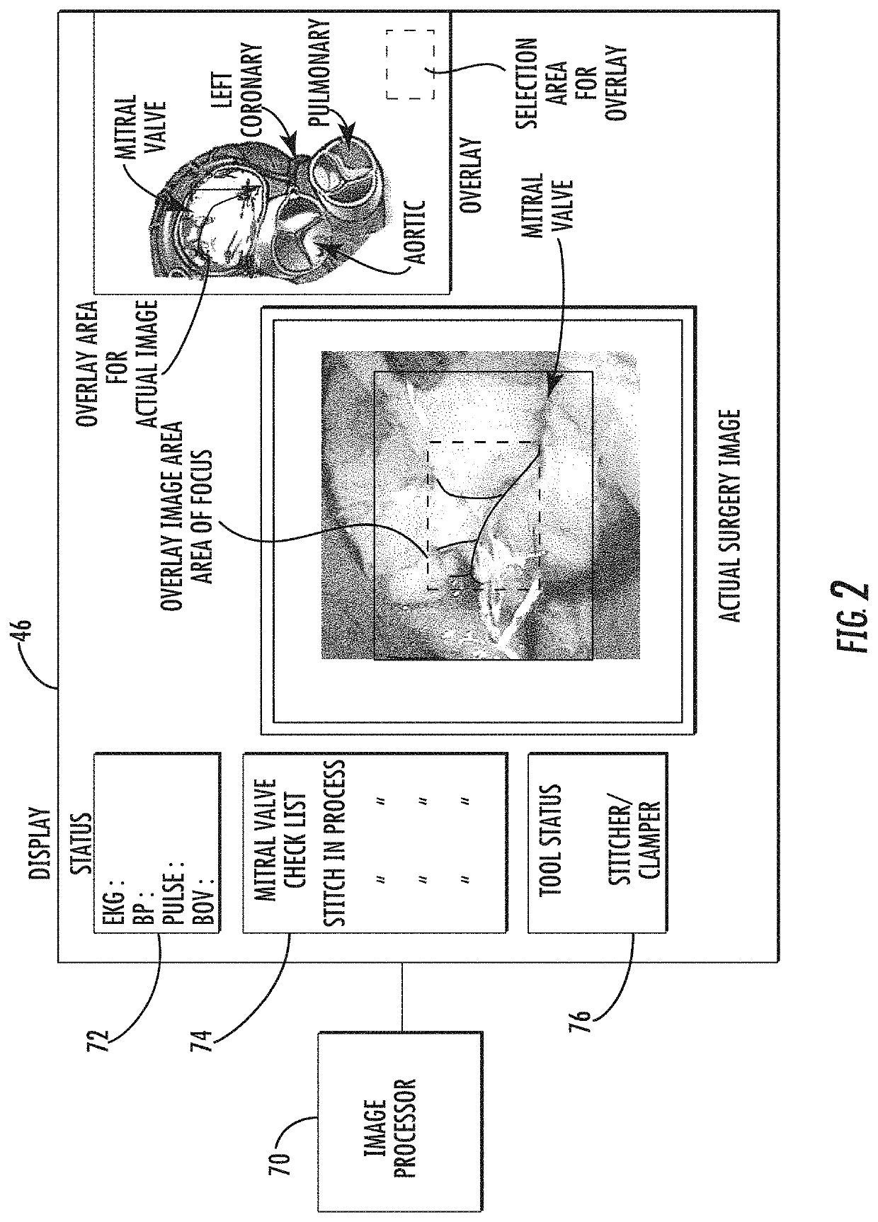 Surgical simulation system using force sensing and optical tracking and robotic surgery system