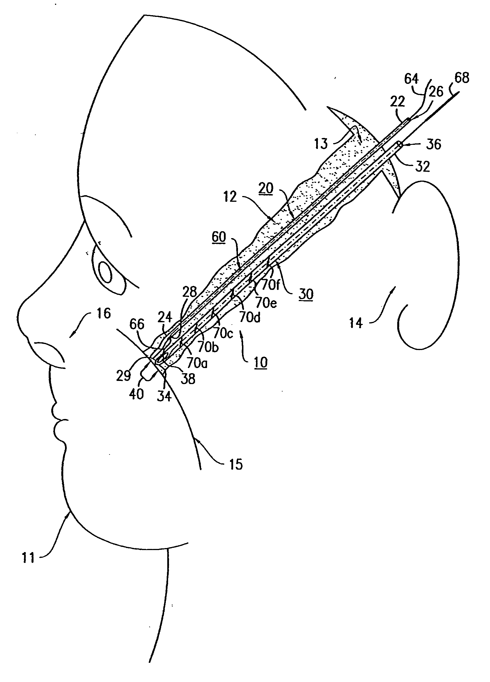 Suture instrument and method of suturing in cosmetic surgery