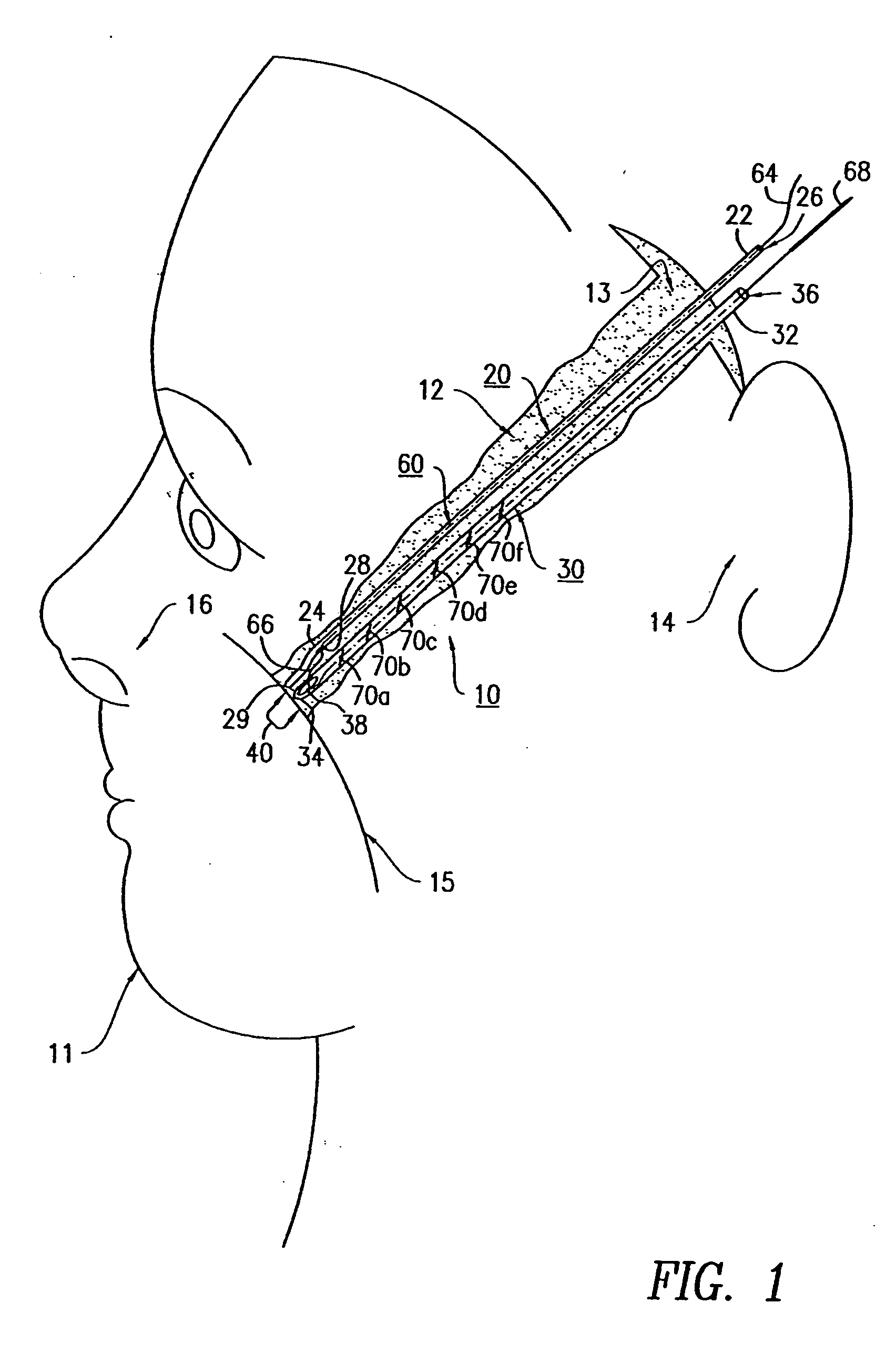 Suture instrument and method of suturing in cosmetic surgery