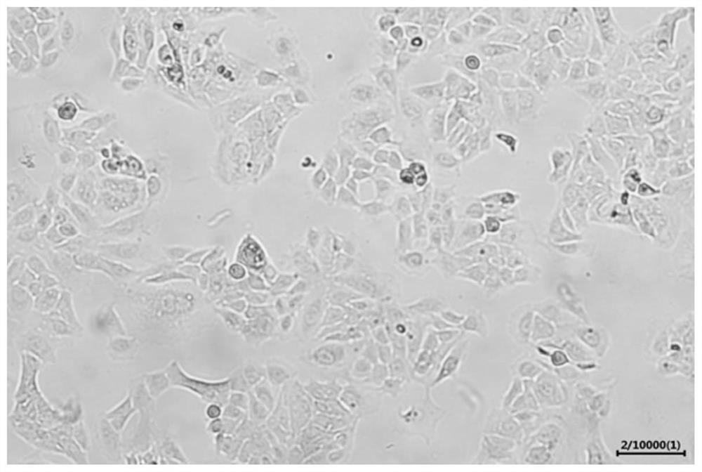 Human ovarian squamous carcinoma cell line and application thereof