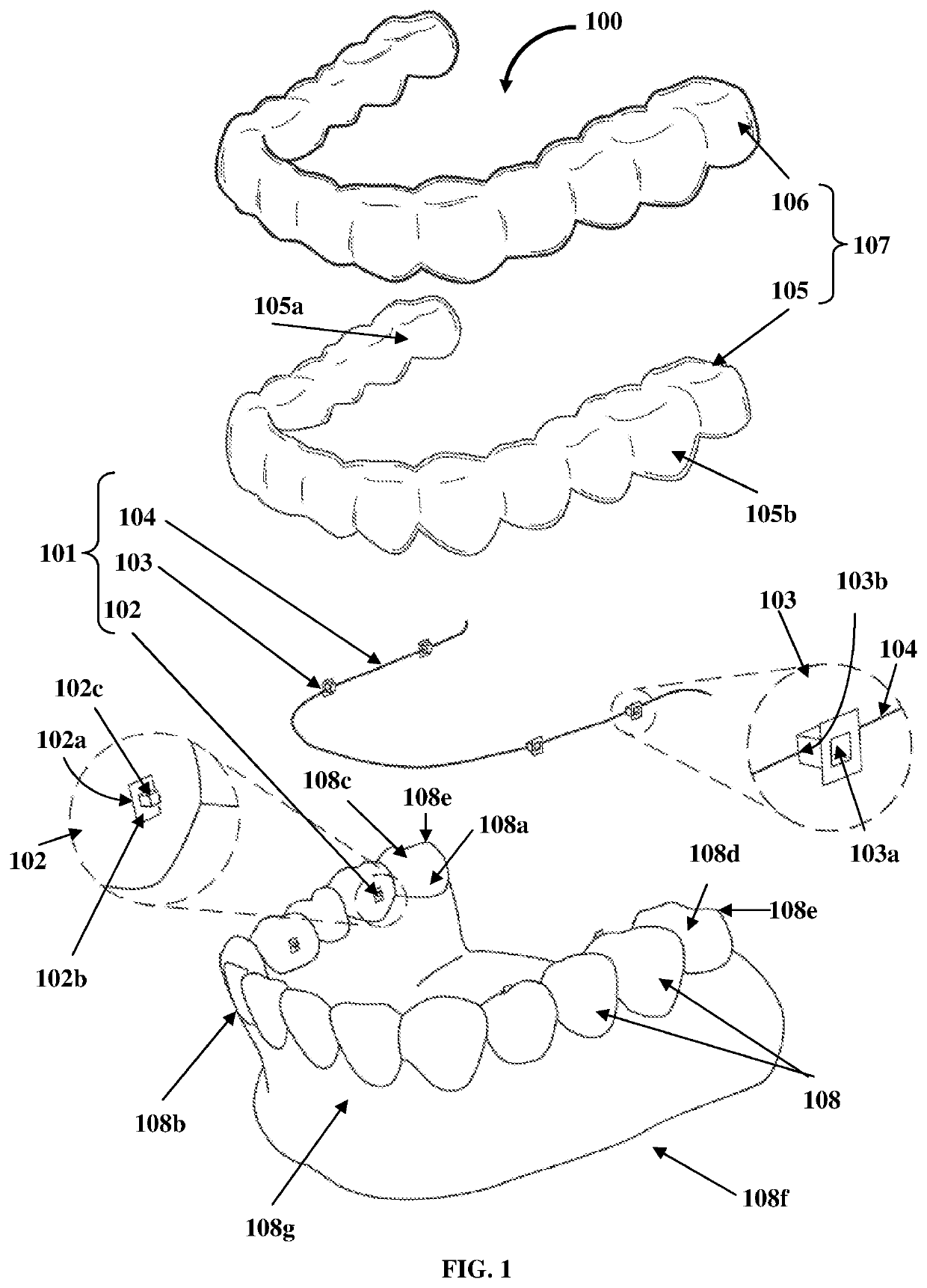 Detachable orthodontic bracket and wire system