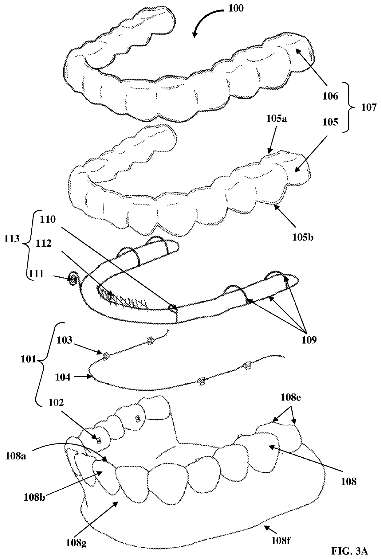 Detachable orthodontic bracket and wire system