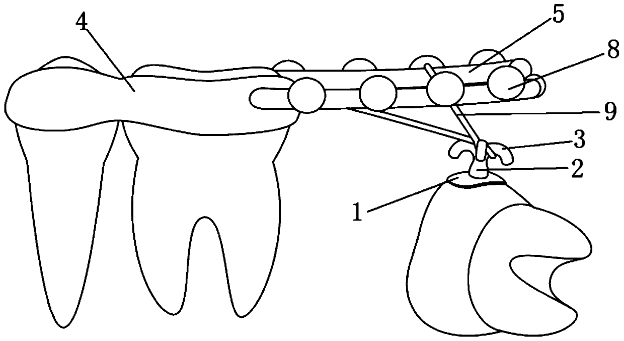 Correcting device and correcting method for traction and straightening of free-end impacted molars