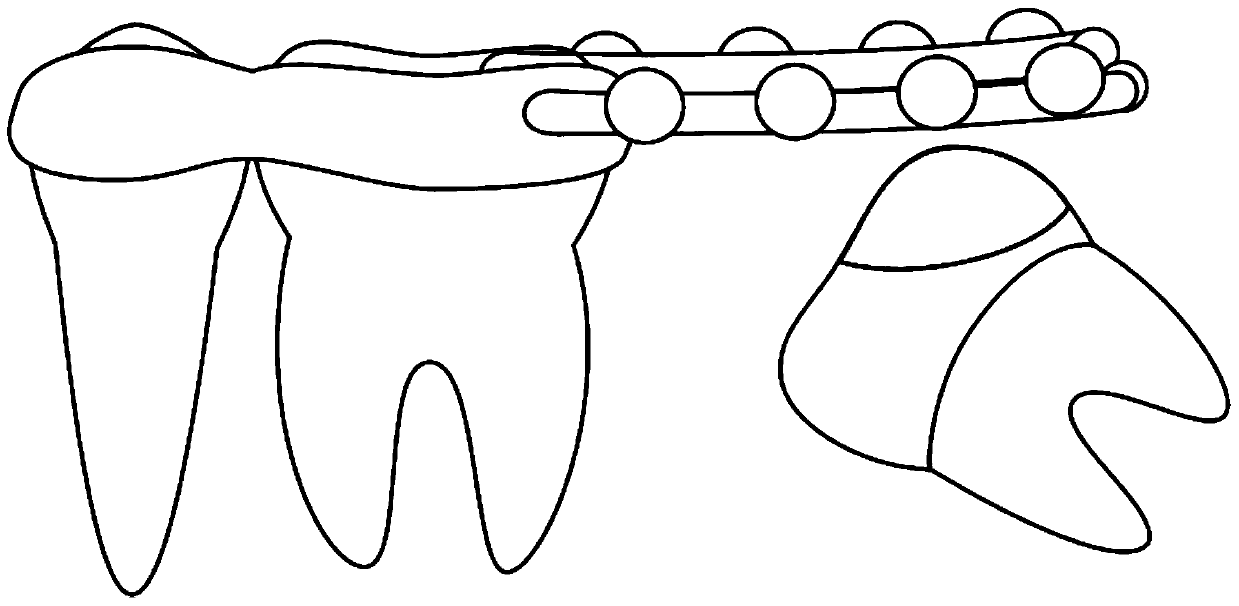 Correcting device and correcting method for traction and straightening of free-end impacted molars