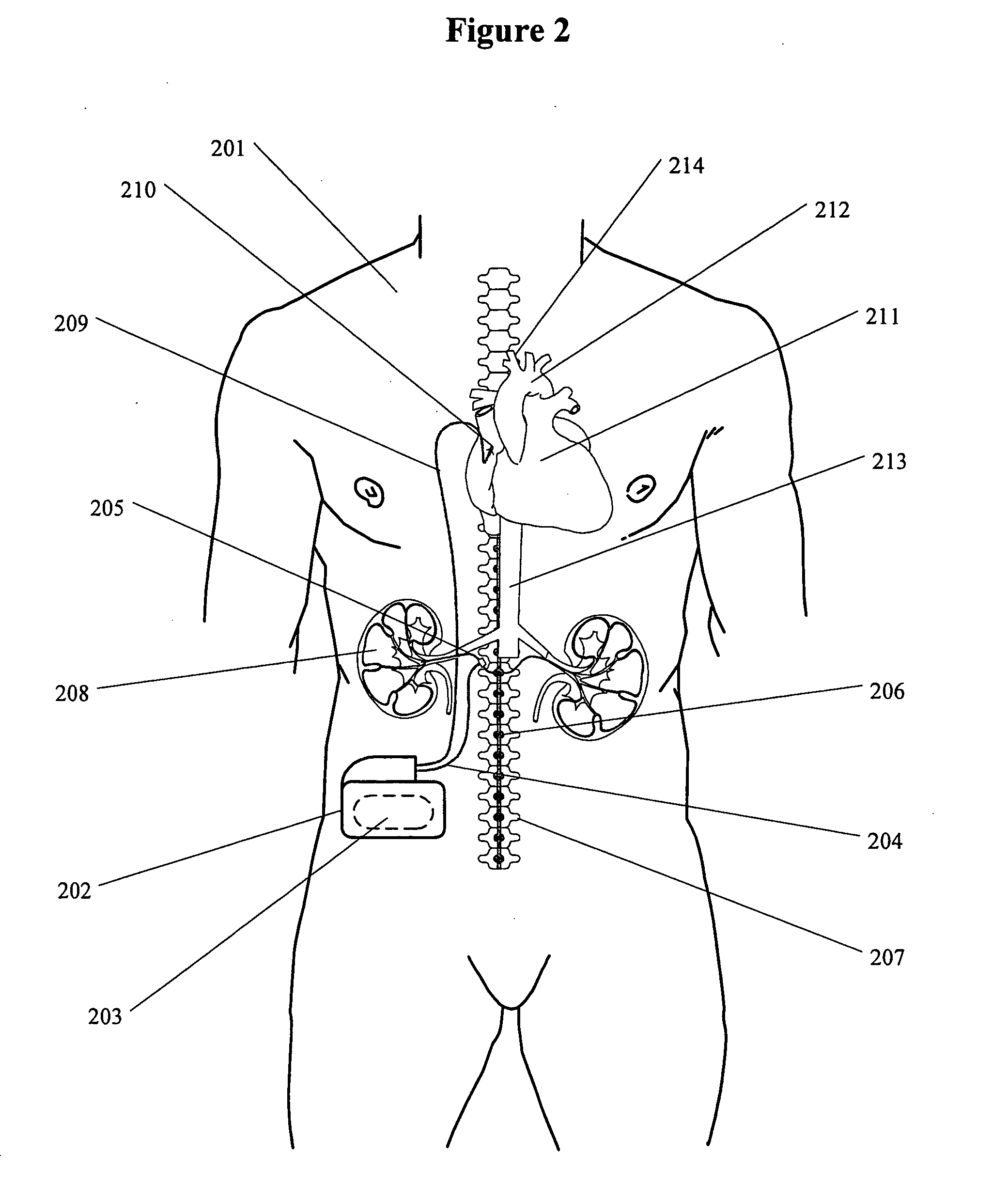 Renal nerve stimulation method and apparatus for treatment of patients