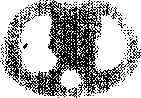 Interation curative wave filtration combined weighted least squares positron emission tomography method