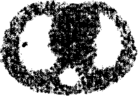 Interation curative wave filtration combined weighted least squares positron emission tomography method