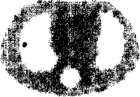 Interation curative wave filtration combined weighted least squares positron emission tomography method