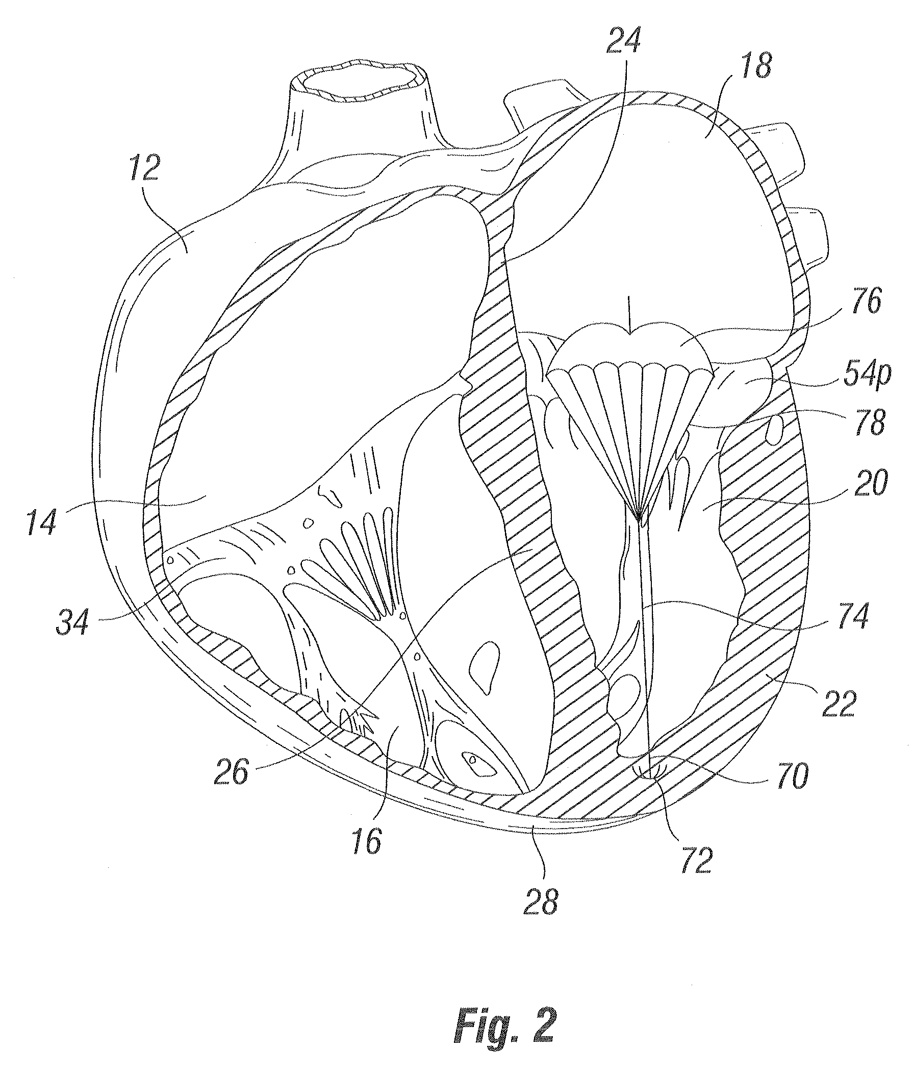 Device and method for improving heart valve function