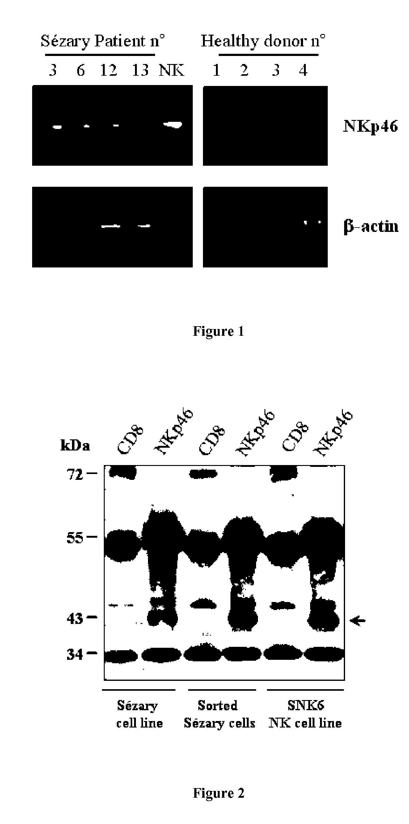 Methods for diagnosis and treatment of cutaneous t cell lymphomas