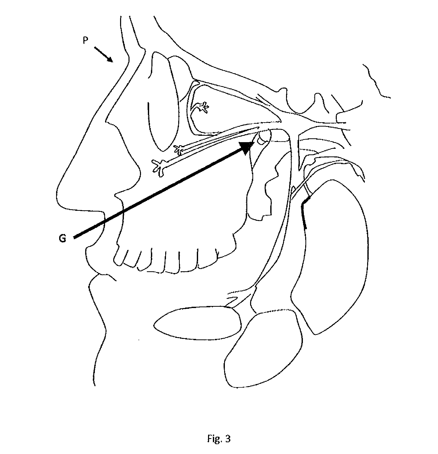 Method, composition and kit for treating frequent headaches
