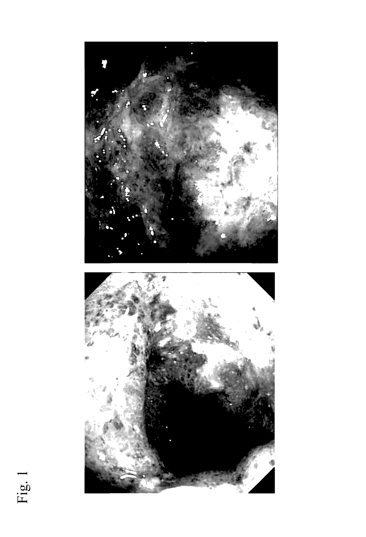 Method for prevention or treatment of intractable inflammatory bowel disease