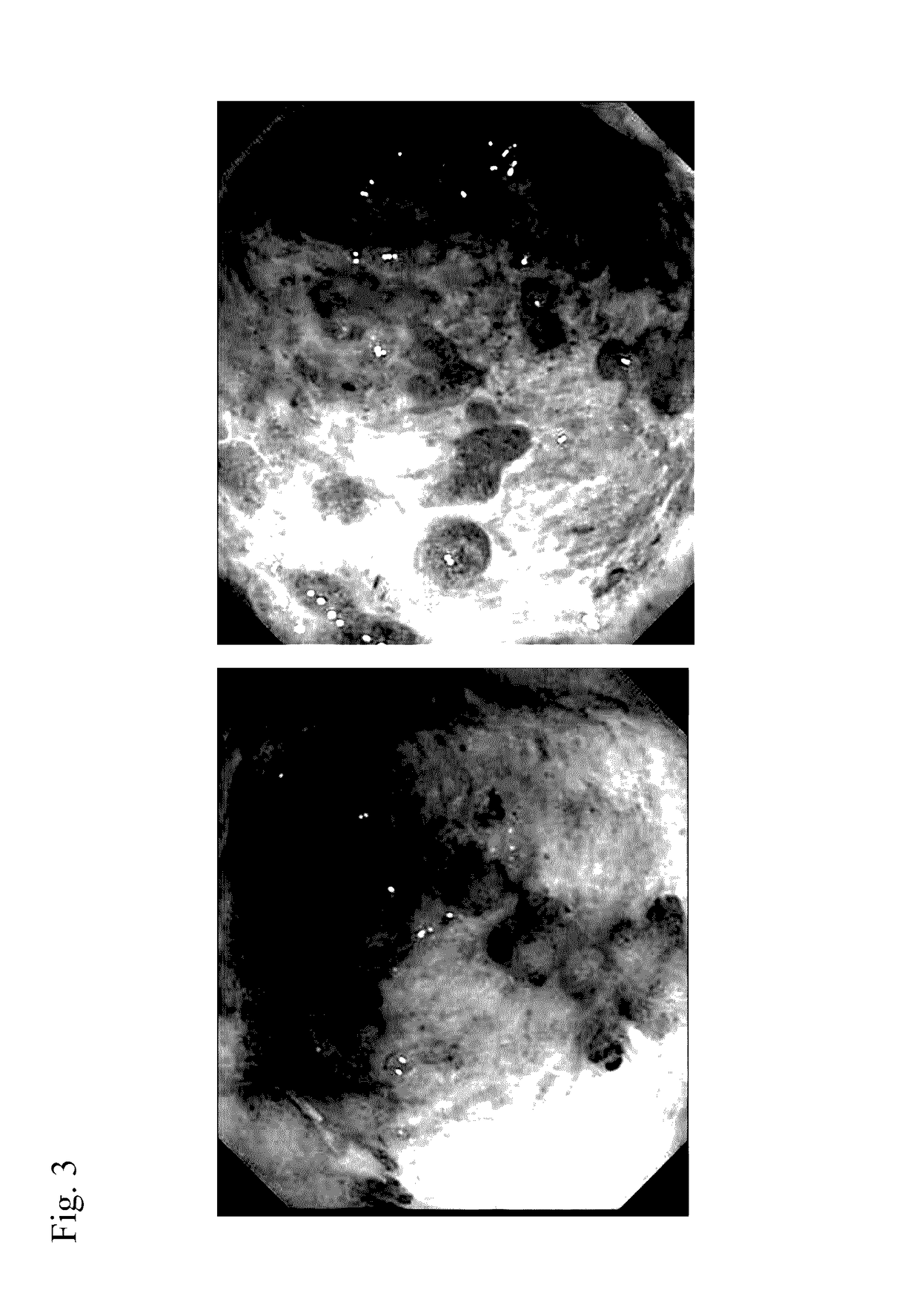 Method for prevention or treatment of intractable inflammatory bowel disease