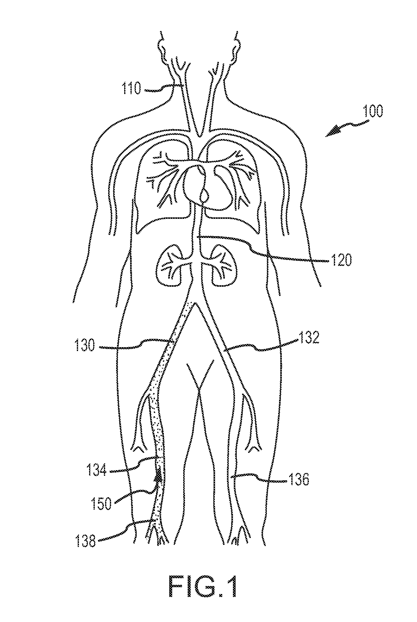 Devices and methods for treating venous diseases
