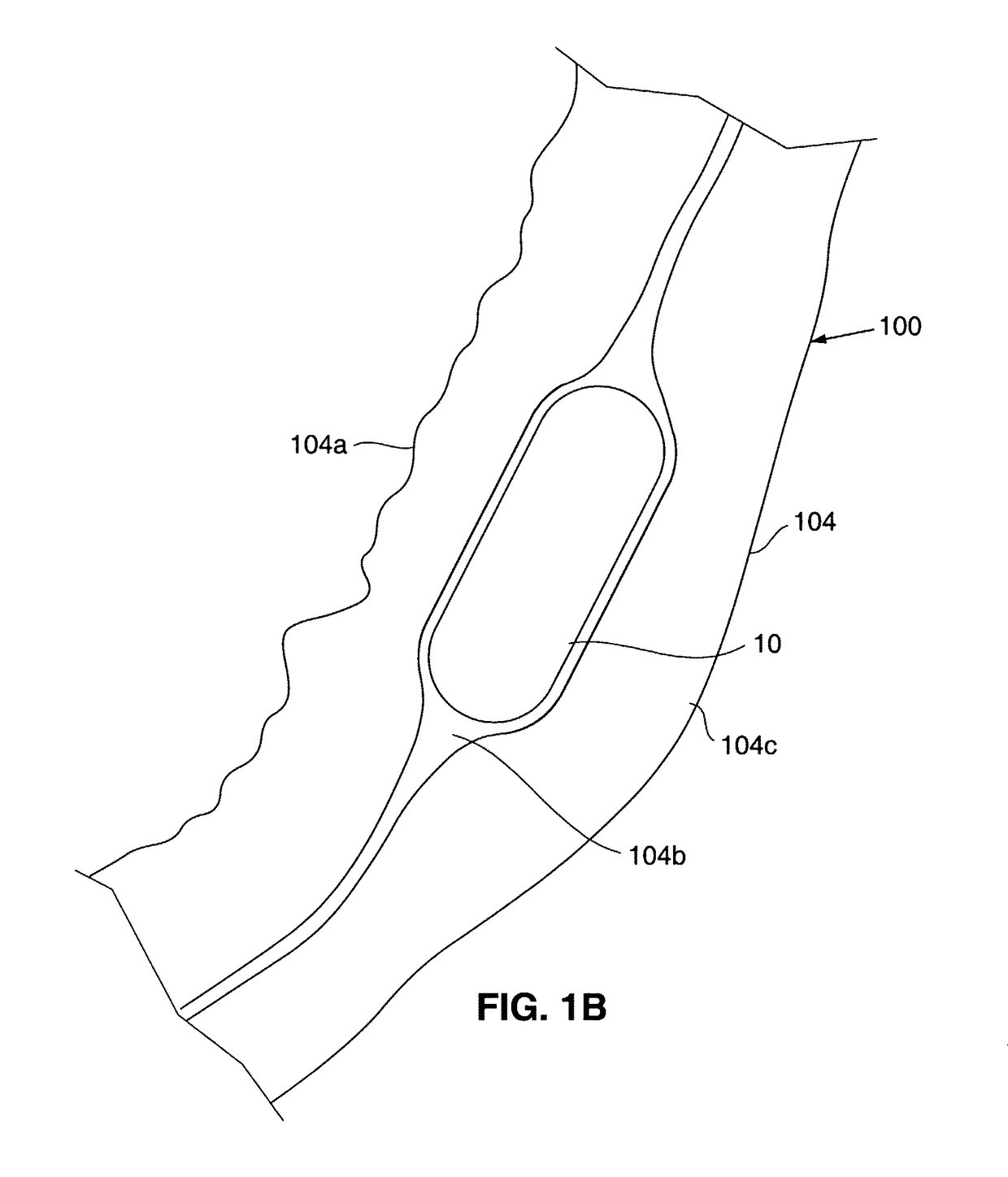 Submucosal gastric implant device and method