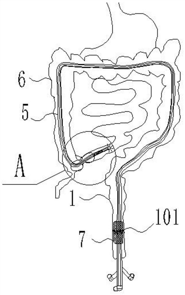 Device and method for preventing anastomotic fistula after colorectal surgery