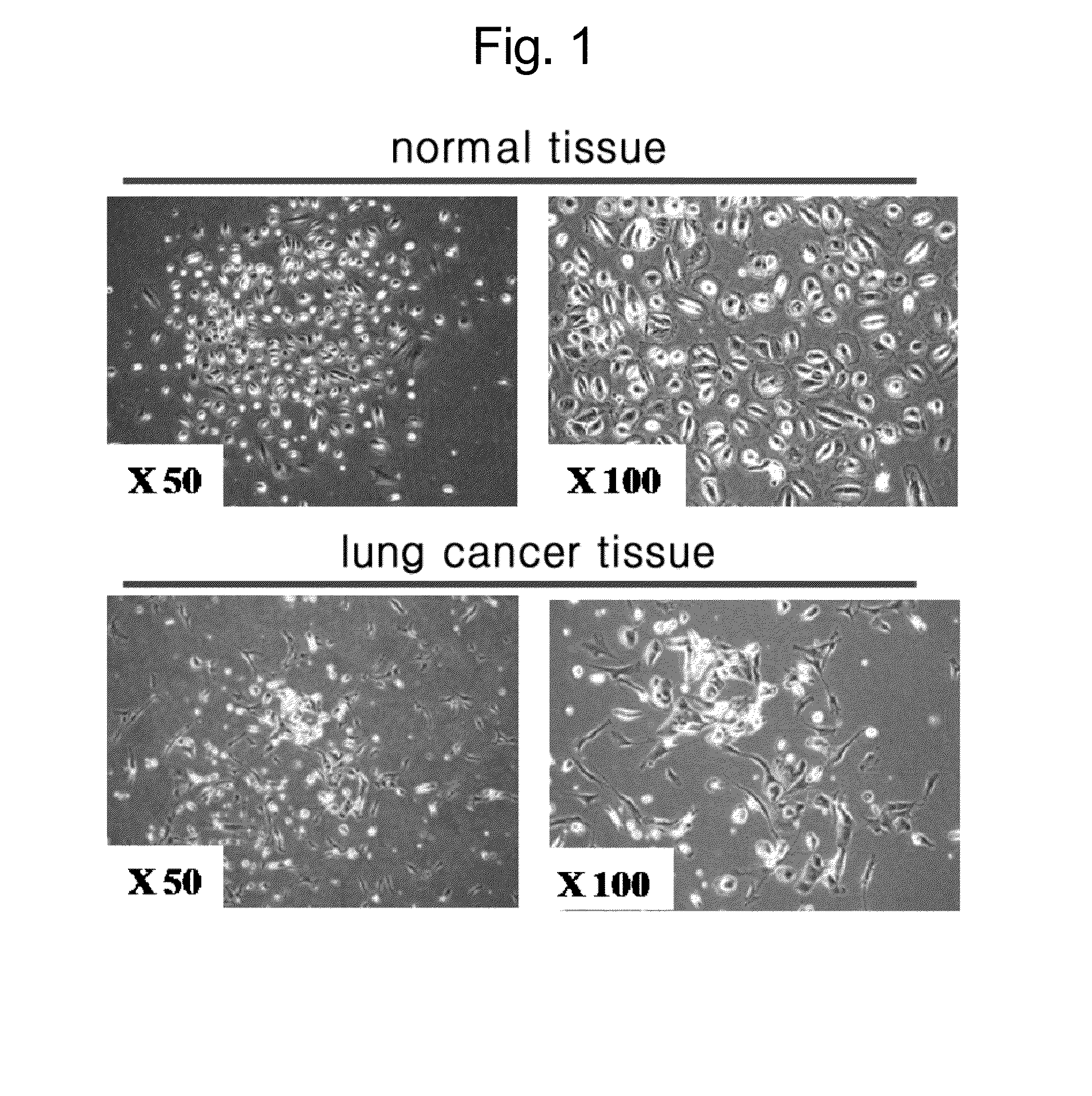 Composition for diagnosis of lung cancer and diagnosis kit of lung cancer