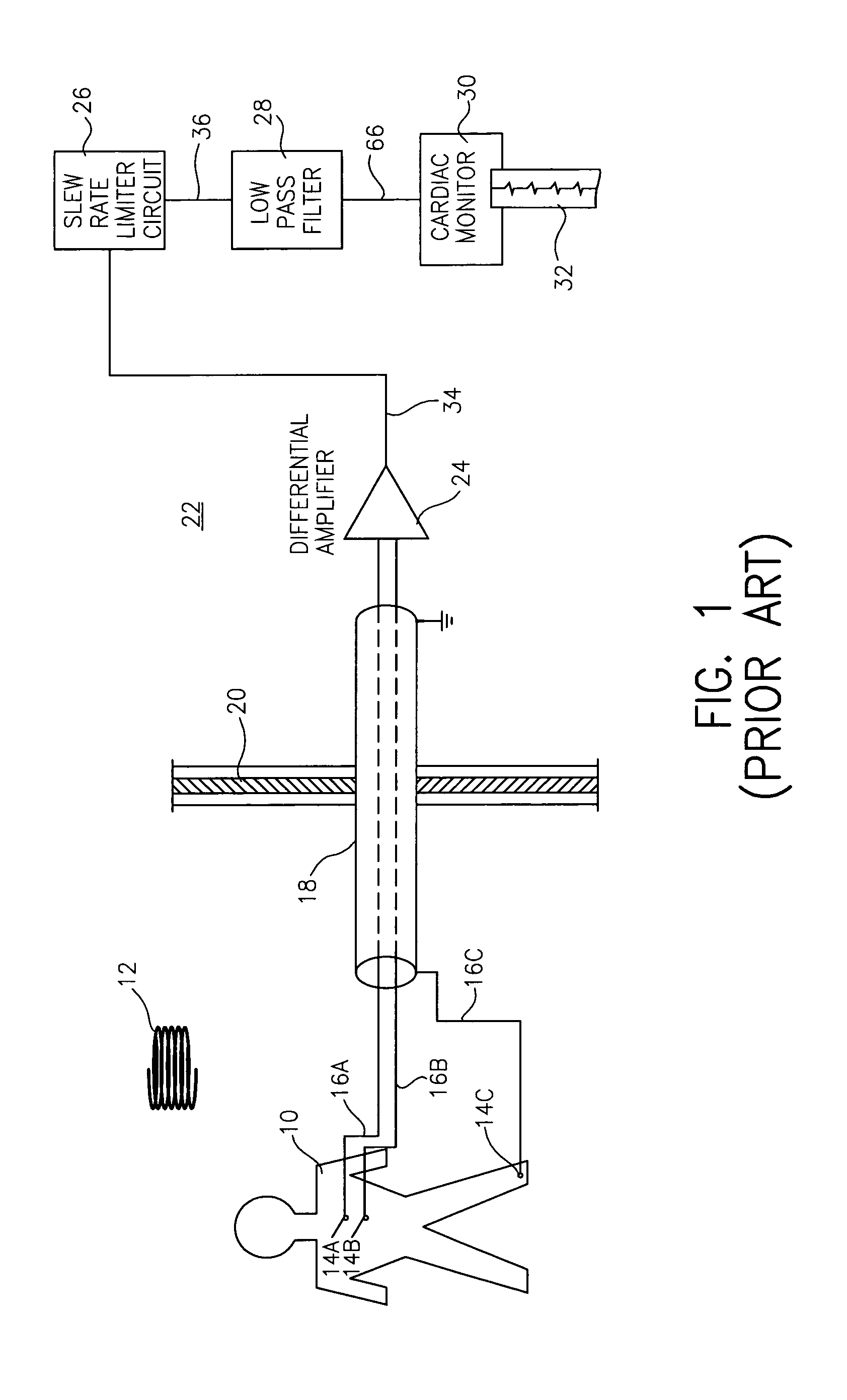 Apparatus and method for removing magnetic resonance imaging-induced noise from ECG signals