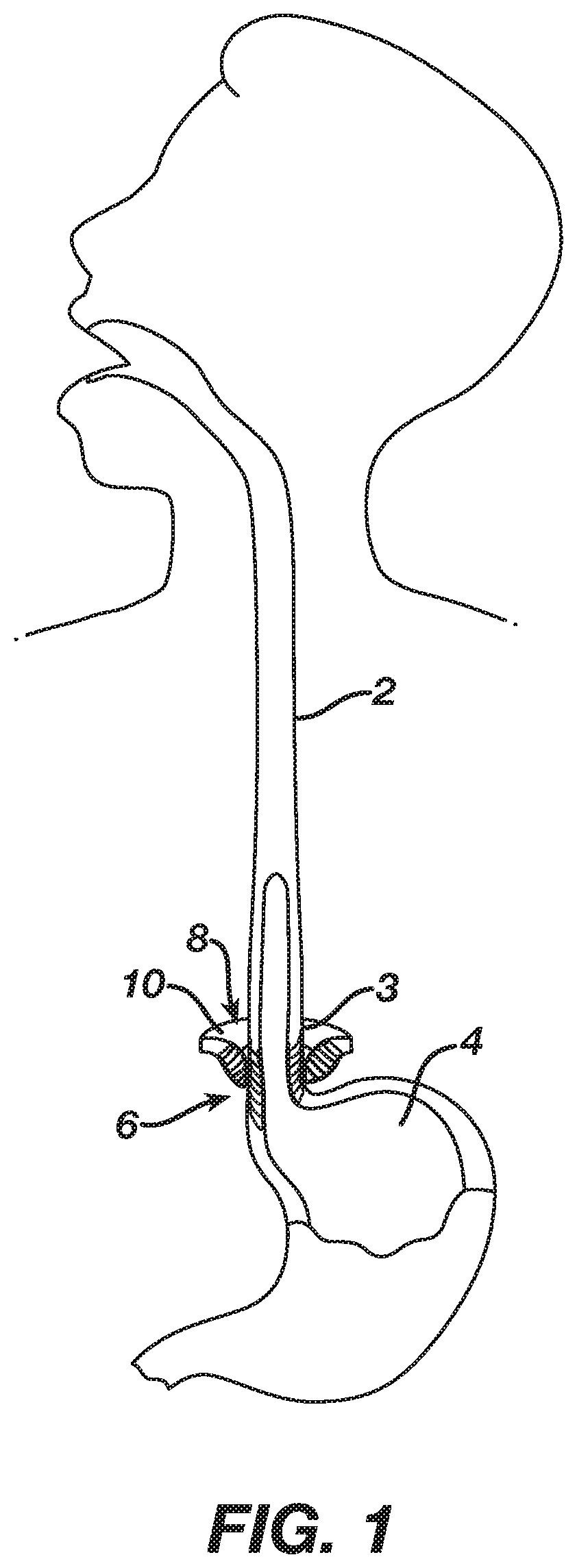 Tunable magnetic sphincter augmentation device