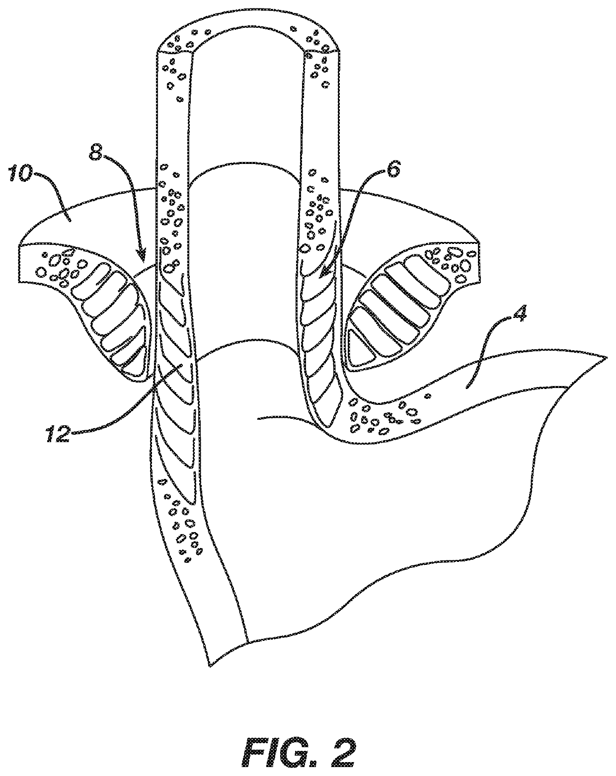 Tunable magnetic sphincter augmentation device