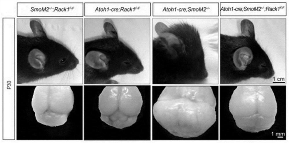 Application of rack1 as a target in the preparation of anti-shh subtype medulloblastoma drugs