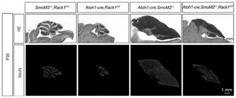 Application of rack1 as a target in the preparation of anti-shh subtype medulloblastoma drugs