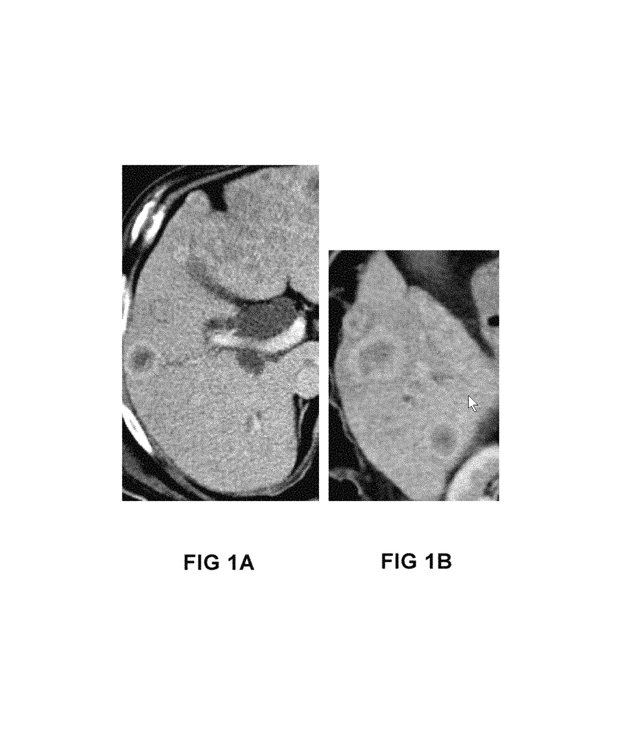 Targeted treatment of anerobic cancer