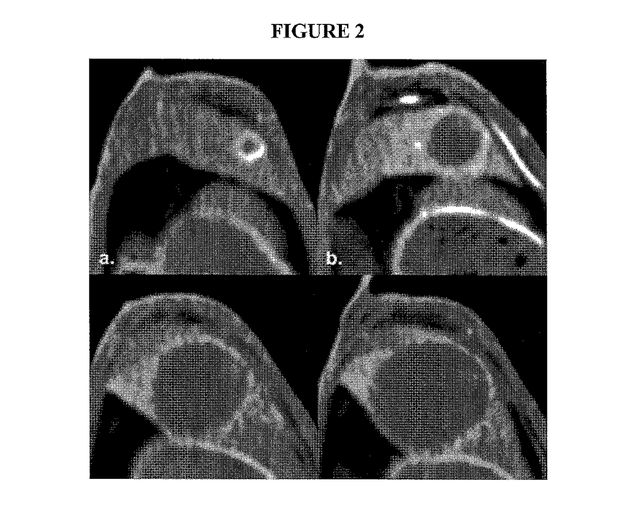 Targeted treatment of anerobic cancer