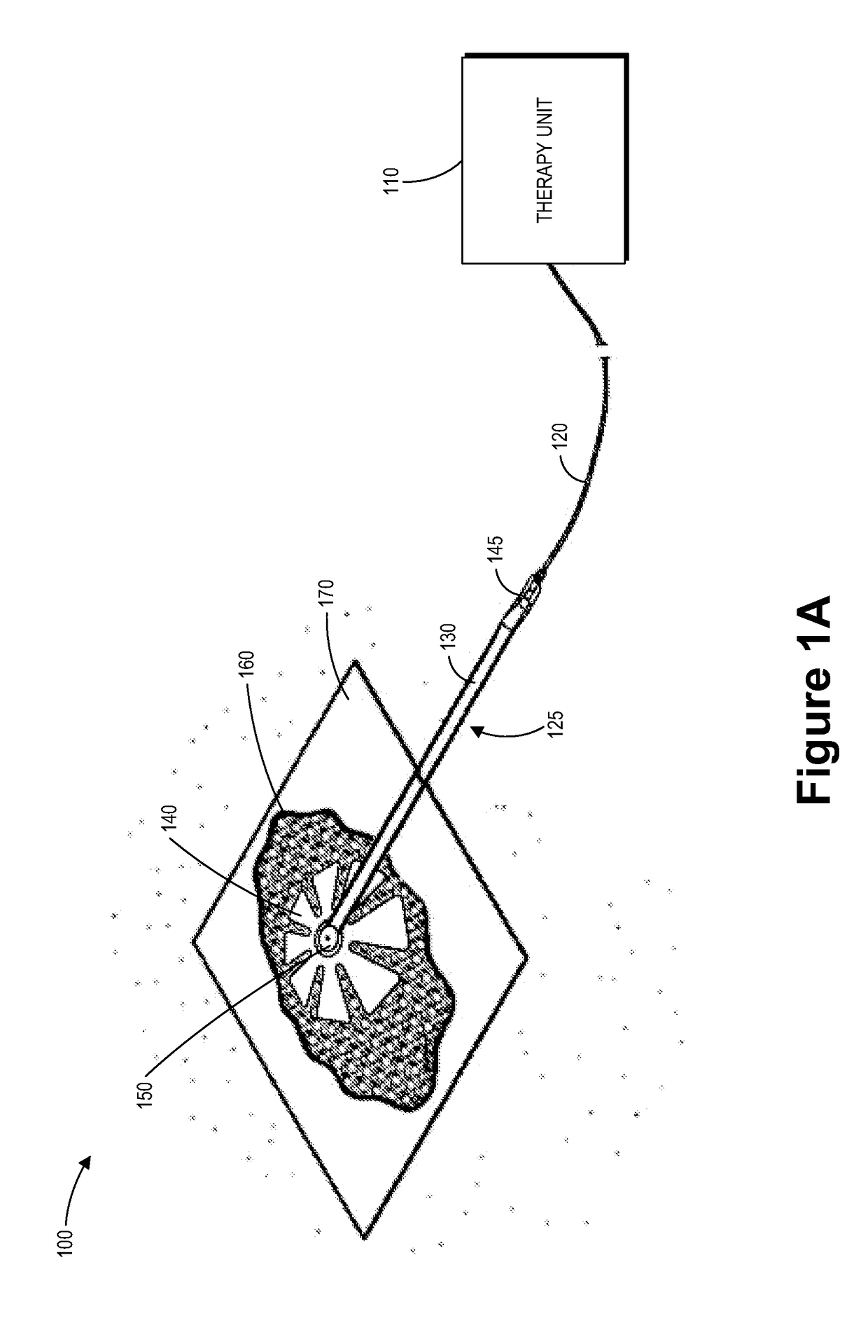 Fluidic connector for irrigation and aspiration of wounds