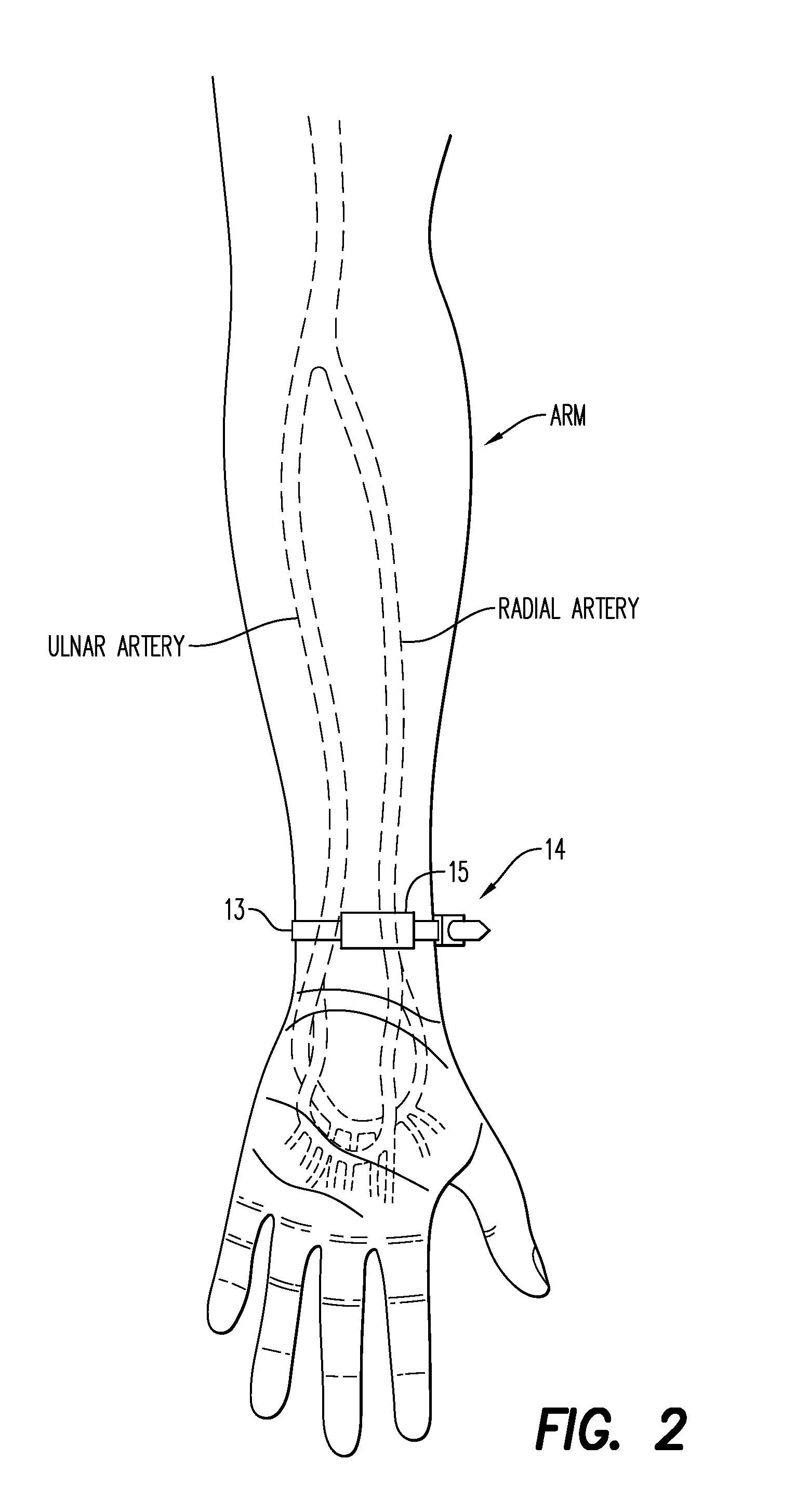 Combination Hemostatic Tablet or Powder and Radial Arterial Compression Band with Syringe Assembly