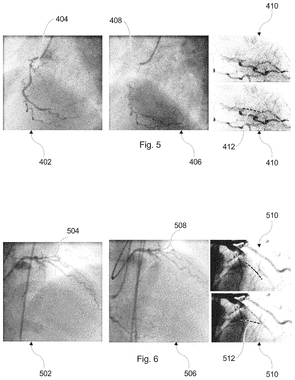 Guidance for treatment of a chronic total occlusion