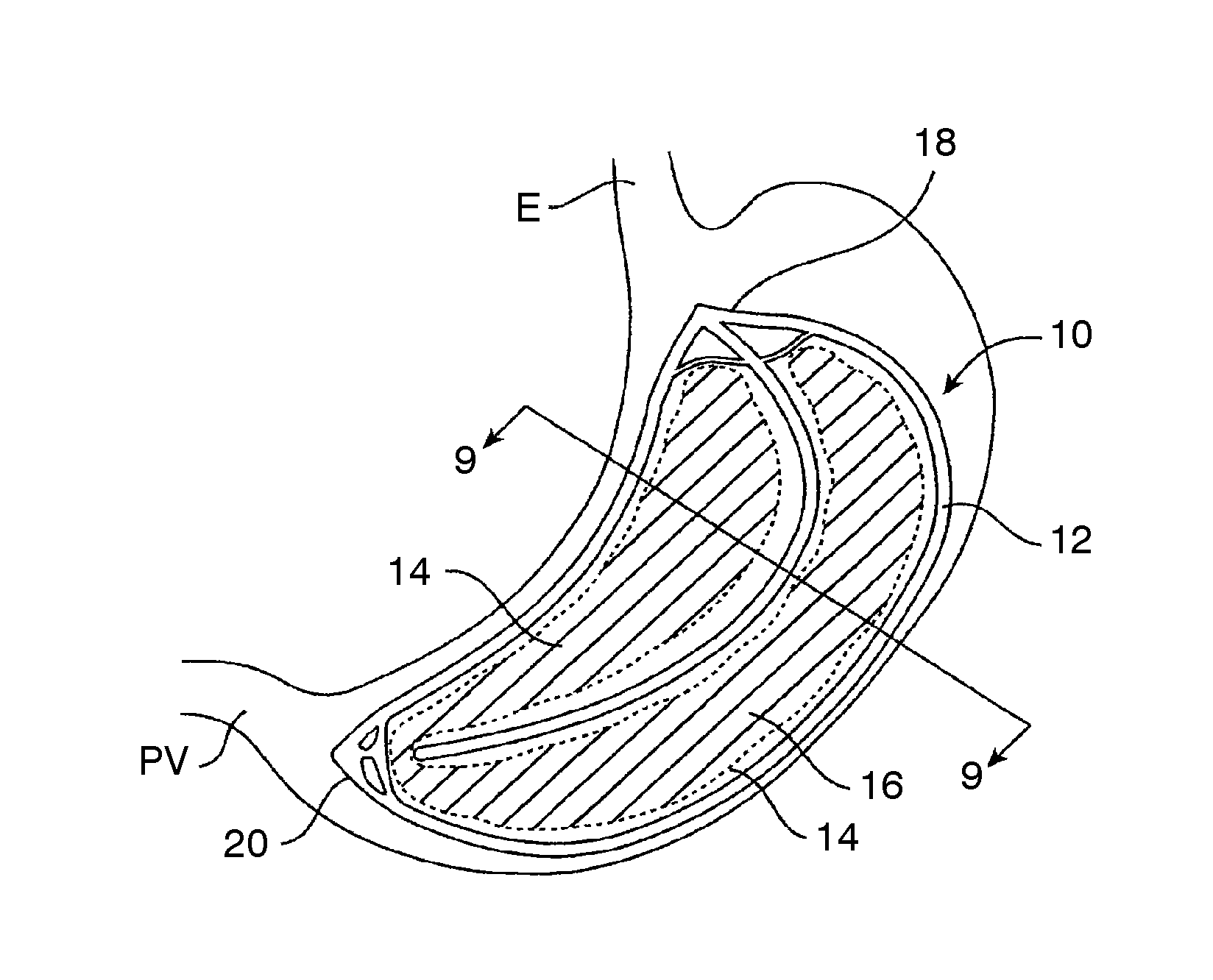 Methods, devices, and systems for obesity treatment